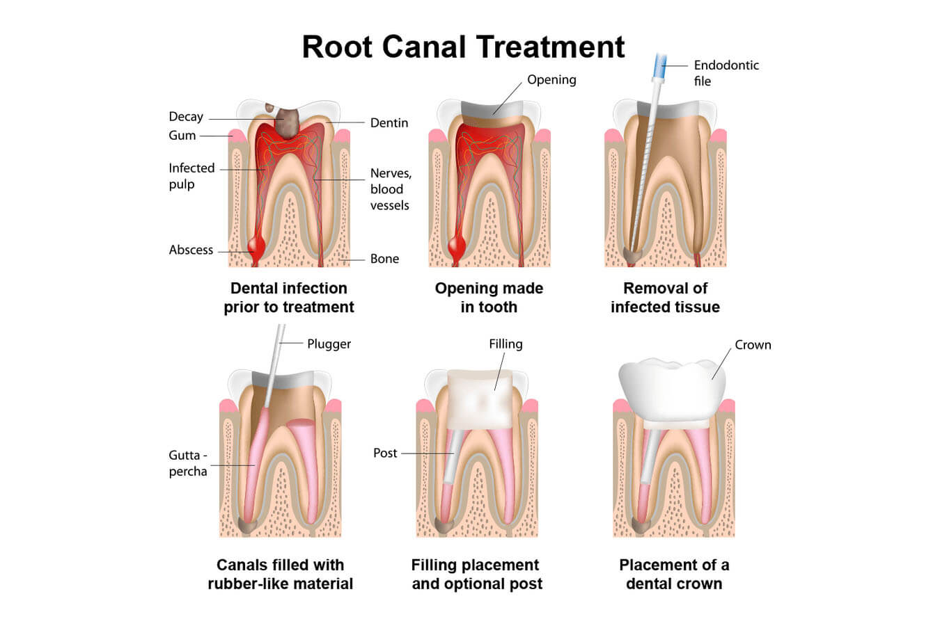 Root Canal Treatment